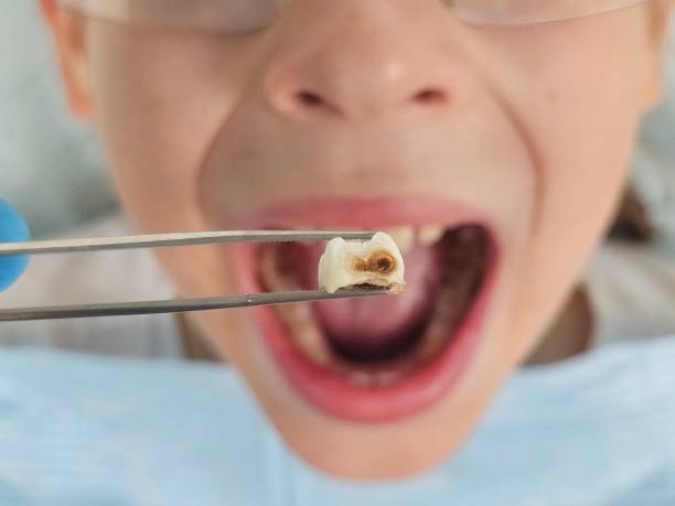 Best Emergency Dental Care for Broken or Chipped Teeth in Fayette, MS